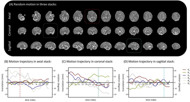 Figure 2 for A Motion Assessment Method for Reference Stack Selection in Fetal Brain MRI Reconstruction Based on Tensor Rank Approximation