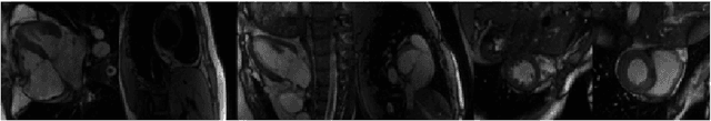 Figure 1 for Deep Cardiac MRI Reconstruction with ADMM