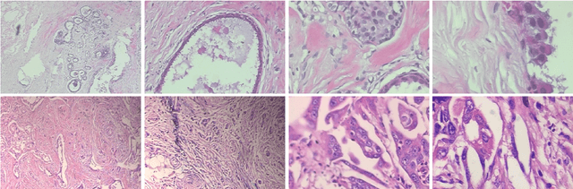 Figure 1 for GroupMixer: Patch-based Group Convolutional Neural Network for Breast Cancer Detection from Histopathological Images