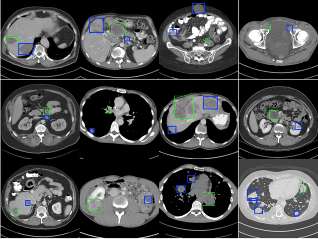 Figure 3 for An End-to-End Framework For Universal Lesion Detection With Missing Annotations