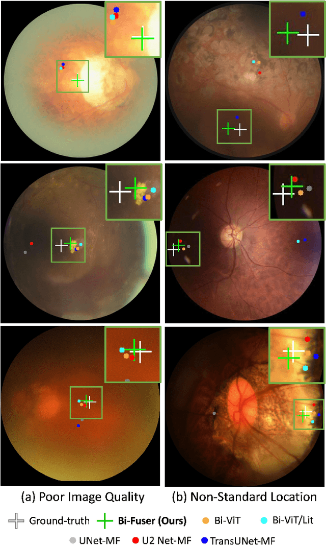 Figure 4 for Bilateral-Fuser: A Novel Multi-cue Fusion Architecture with Anatomical-aware Tokens for Fovea Localization