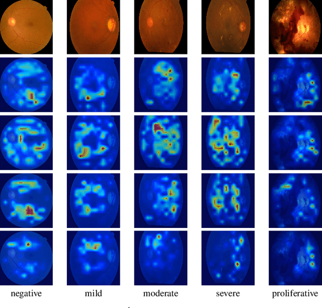 Figure 2 for Detecting Severity of Diabetic Retinopathy from Fundus Images using Ensembled Transformers