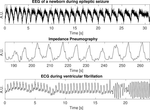Figure 1 for Fully Adaptive Time-Varying Wave-Shape Model: Applications in Biomedical Signal Processing