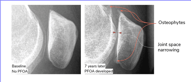Figure 3 for Deep Learning for Predicting Progression of Patellofemoral Osteoarthritis Based on Lateral Knee Radiographs, Demographic Data and Symptomatic Assessments
