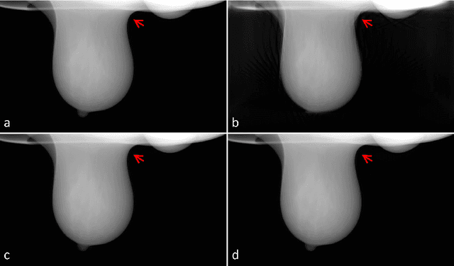 Figure 2 for Sub-volume-based Denoising Diffusion Probabilistic Model for Cone-beam CT Reconstruction from Incomplete Data