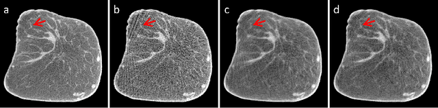 Figure 3 for Sub-volume-based Denoising Diffusion Probabilistic Model for Cone-beam CT Reconstruction from Incomplete Data