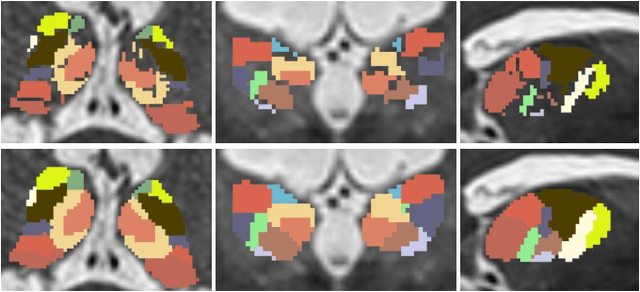 Figure 4 for Label Propagation via Random Walk for Training Robust Thalamus Nuclei Parcellation Model from Noisy Annotations