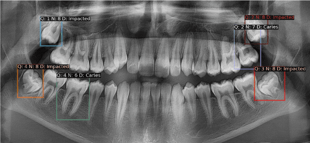 Figure 2 for DENTEX: An Abnormal Tooth Detection with Dental Enumeration and Diagnosis Benchmark for Panoramic X-rays