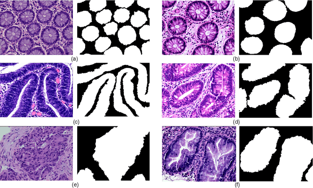 Figure 2 for EBHI-Seg: A Novel Enteroscope Biopsy Histopathological Haematoxylin and Eosin Image Dataset for Image Segmentation Tasks