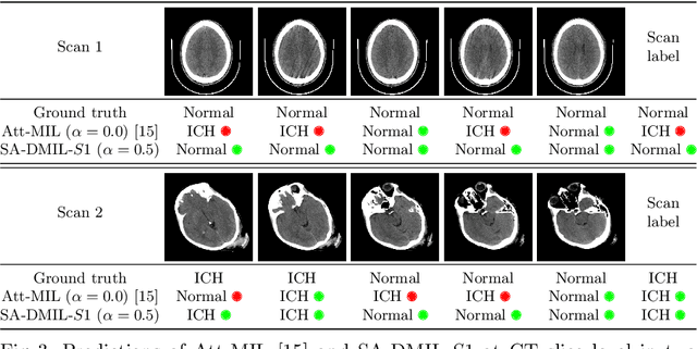 Figure 4 for Smooth Attention for Deep Multiple Instance Learning: Application to CT Intracranial Hemorrhage Detection
