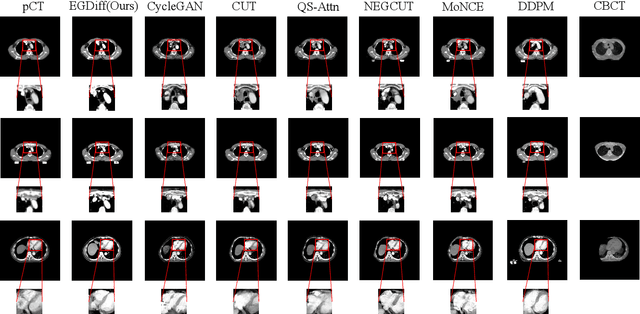 Figure 3 for Energy-Guided Diffusion Model for CBCT-to-CT Synthesis