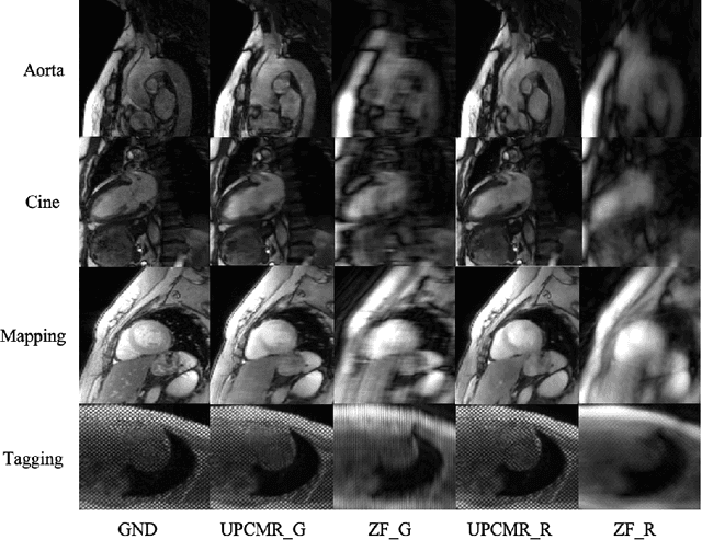 Figure 3 for UPCMR: A Universal Prompt-guided Model for Random Sampling Cardiac MRI Reconstruction