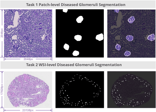 Figure 1 for KPIs 2024 Challenge: Advancing Glomerular Segmentation from Patch- to Slide-Level