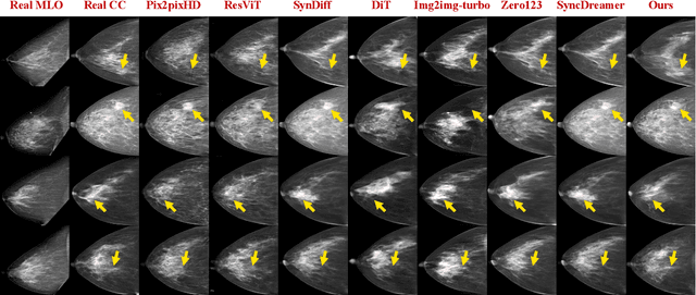 Figure 4 for Bidirectional Mammogram View Translation with Column-Aware and Implicit 3D Conditional Diffusion