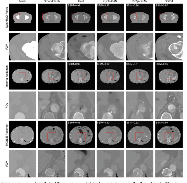 Figure 3 for seg2med: a segmentation-based medical image generation framework using denoising diffusion probabilistic models