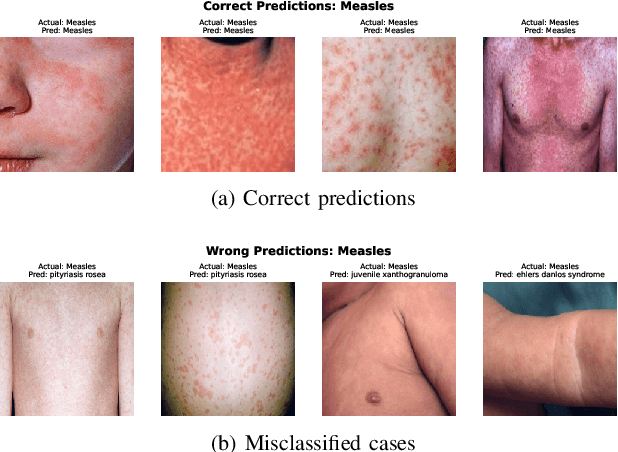 Figure 2 for Toward Accessible Dermatology: Skin Lesion Classification Using Deep Learning Models on Mobile-Acquired Images