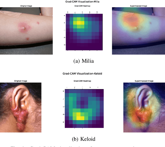 Figure 4 for Toward Accessible Dermatology: Skin Lesion Classification Using Deep Learning Models on Mobile-Acquired Images
