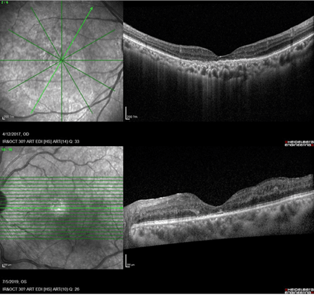 Figure 1 for Predicting Diabetic Macular Edema Treatment Responses Using OCT: Dataset and Methods of APTOS Competition