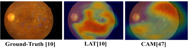 Figure 4 for Local-to-Global Self-Supervised Representation Learning for Diabetic Retinopathy Grading