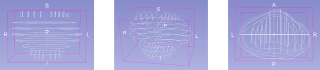 Figure 3 for Volumetric Reconstruction of Prostatectomy Specimens from Histology