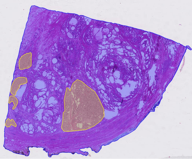 Figure 4 for Volumetric Reconstruction of Prostatectomy Specimens from Histology