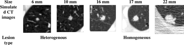 Figure 1 for VLST: Virtual Lung Screening Trial for Lung Cancer Detection Using Virtual Imaging Trial