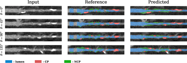 Figure 4 for Automatic Coronary Artery Plaque Quantification and CAD-RADS Prediction using Mesh Priors