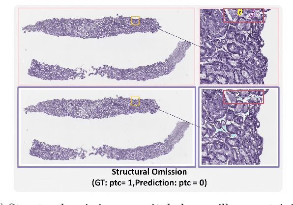 Figure 4 for How Close Are We? Limitations and Progress of AI Models in Banff Lesion Scoring
