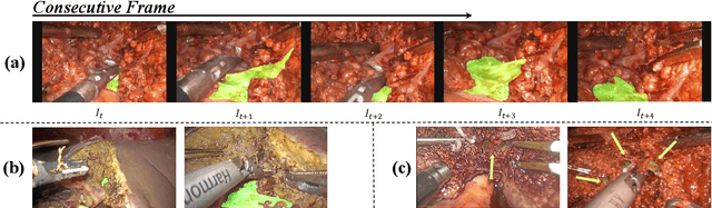 Figure 1 for HRVVS: A High-resolution Video Vasculature Segmentation Network via Hierarchical Autoregressive Residual Priors