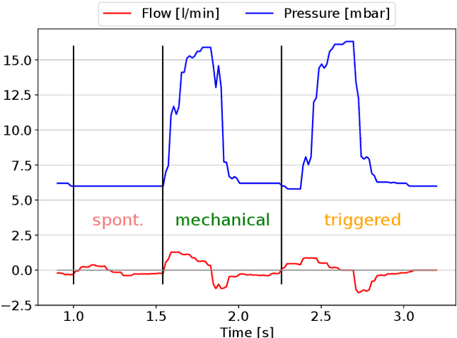 Figure 3 for Evaluating the Explainable AI Method Grad-CAM for Breath Classification on Newborn Time Series Data