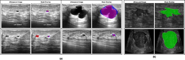 Figure 1 for Towards Trustworthy Breast Tumor Segmentation in Ultrasound using Monte Carlo Dropout and Deep Ensembles for Epistemic Uncertainty Estimation