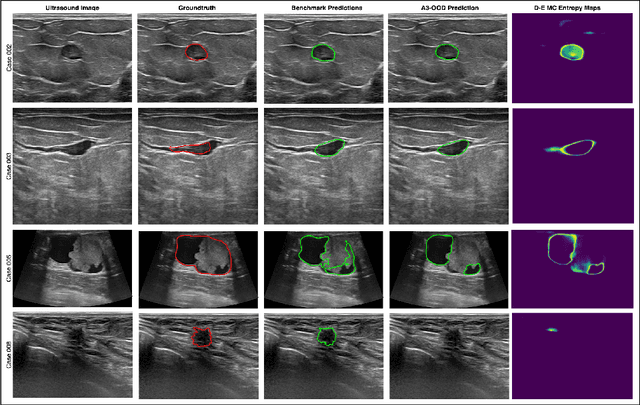 Figure 3 for Towards Trustworthy Breast Tumor Segmentation in Ultrasound using Monte Carlo Dropout and Deep Ensembles for Epistemic Uncertainty Estimation