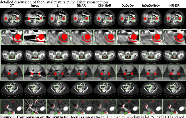 Figure 2 for Diffusion Model Regularized Implicit Neural Representation for CT Metal Artifact Reduction
